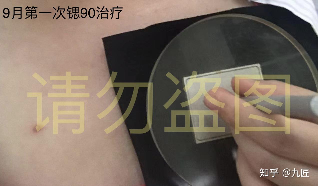 疤痕疙瘩-同位素治療嘗試 - 