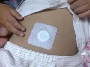 小兒積滯，秘密武器來幫你——敷貼器